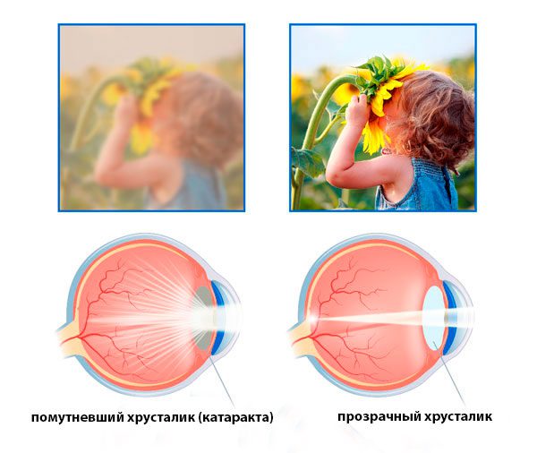Малоинвазивная хирургия катаракты