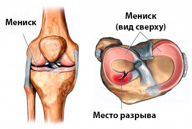 Разрыв мениска