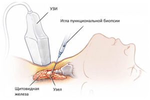 Биопсия щитовидной железы в Запорожье