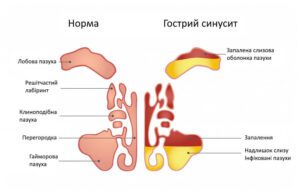 Операція при синуситі у Запоріжжі