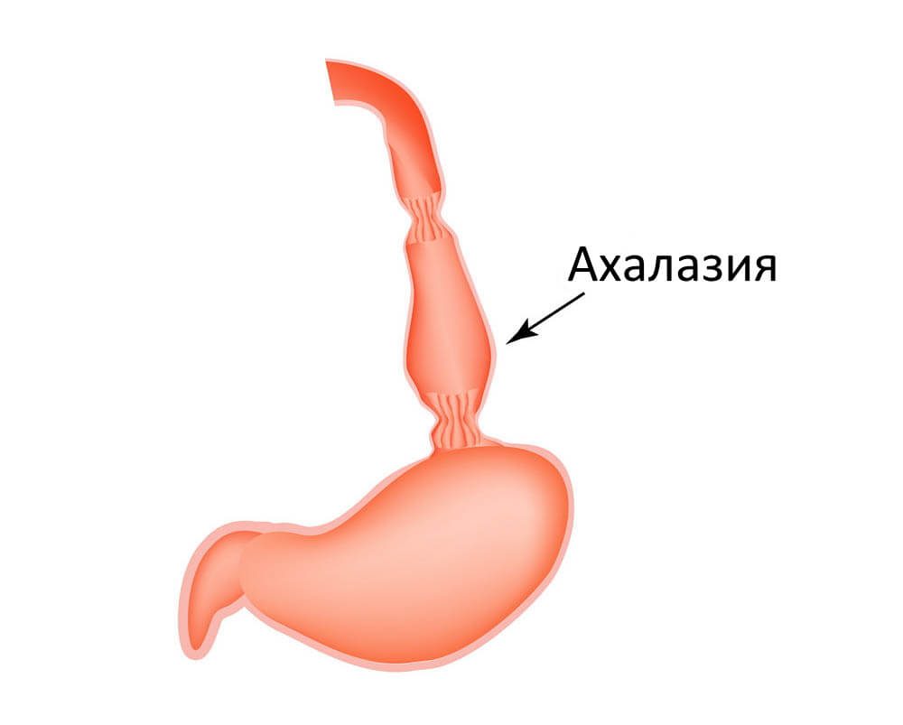 Схема ахалазии кардии