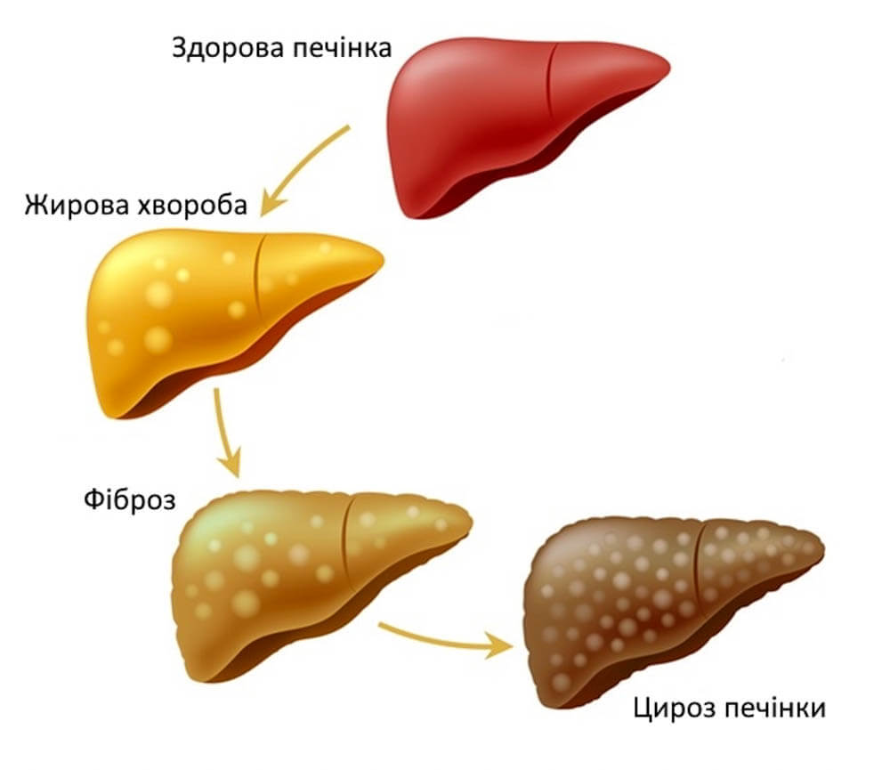 Лікування цирозу печінки у Запоріжжі