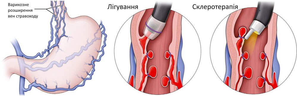 Лігування судин стравоходу у Запоріжжі