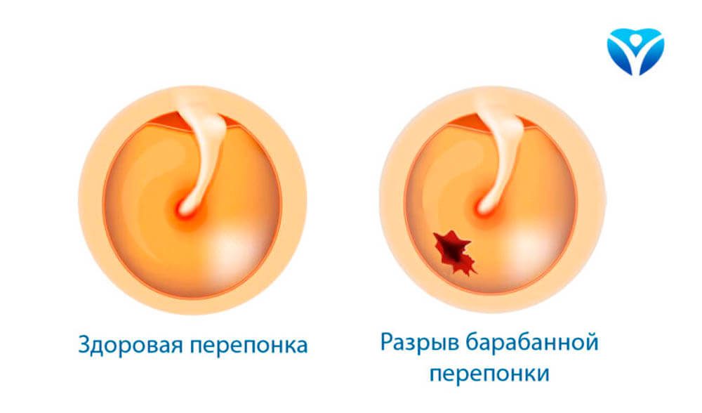 Тимпанопластика в областной клинической больнице Запорожья