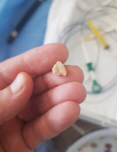 Специалисты больницы достали из легкого пациентки зуб в ЗОКБ