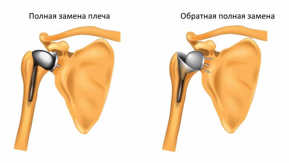 Рисунок схема эндопротезирование плечевого сустава