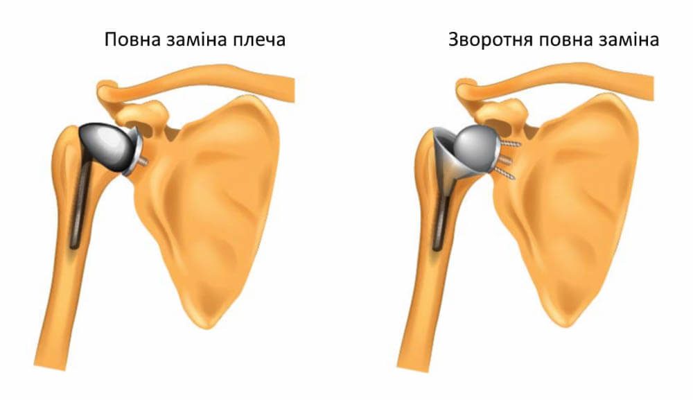 Малюнок схема ендопротезування плечового суглоба у Запоріжжі