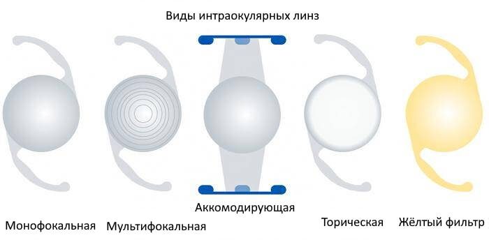 Лечение катаракты в Запорожье Лечение катаракты в Запорожье
