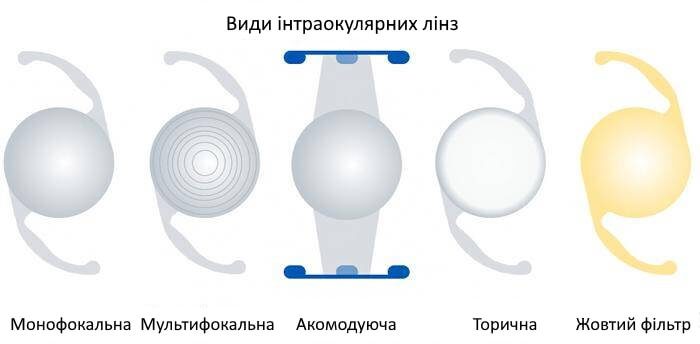 Лікування катаракти у Запоріжжі