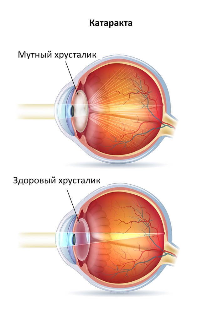 Лечение катаракты в Запорожье Лечение катаракты в Запорожье
