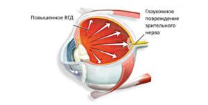 Лечение вторичной неоваскулярной глаукомы в Запорожье