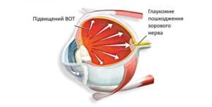Лікування вторинної глаукоми у Запоріжжі