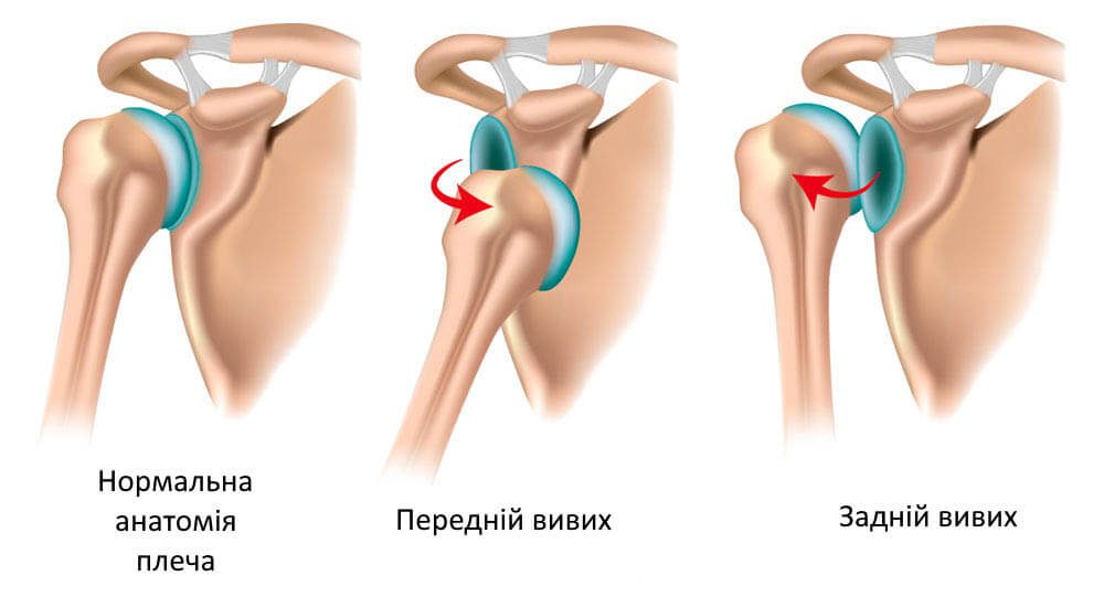 Лікування вивиху плеча у Запоріжжі