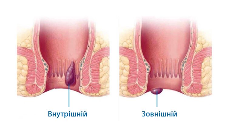 Лазерне лікування геморою у Запоріжжі