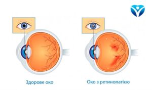 Лікування діабетичної ретинопатії у Запоріжжі