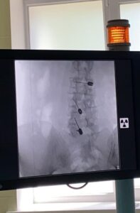 Удаление грыжи без разреза в Запорожье