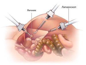 Лапароскопия в Запорожье