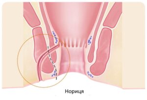 Лазерне видалення нориць прямої кишки у Запоріжжі