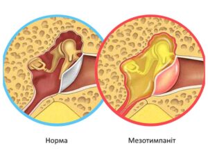 Лікування мезотимпаніту в Запоріжжі
