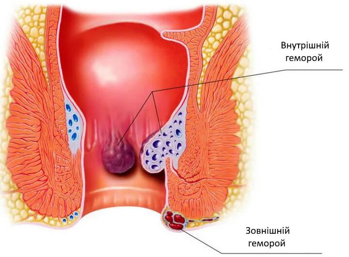 Лікування гострого геморою у Запоріжжі