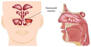 Лікування поліпозного риносинуситу в Запоріжжі Лікування поліпозного риносинуситу в Запоріжжі