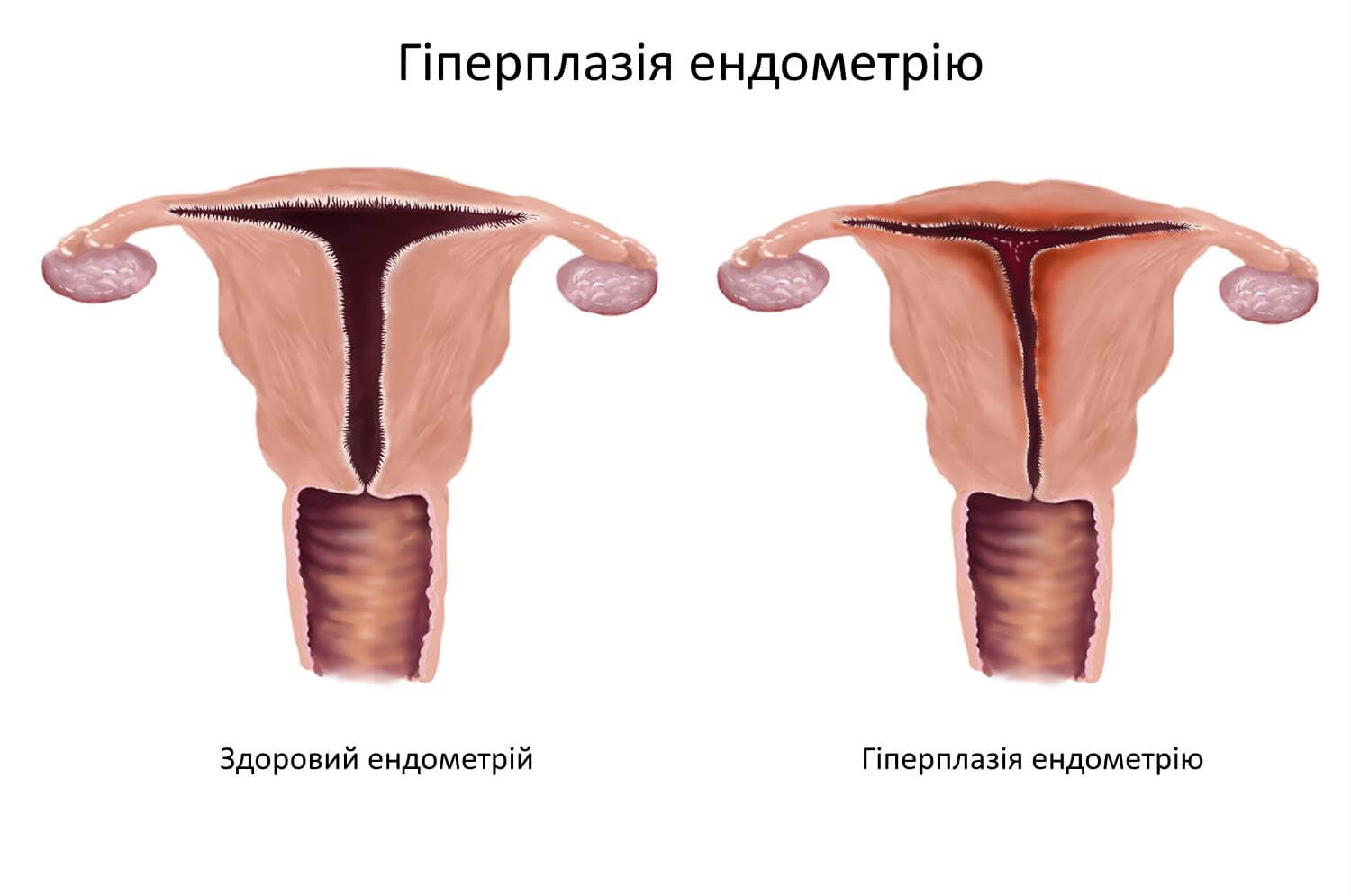Гіперплазія ендометрію у Запоріжжі Гіперплазія ендометрію у Запоріжжі