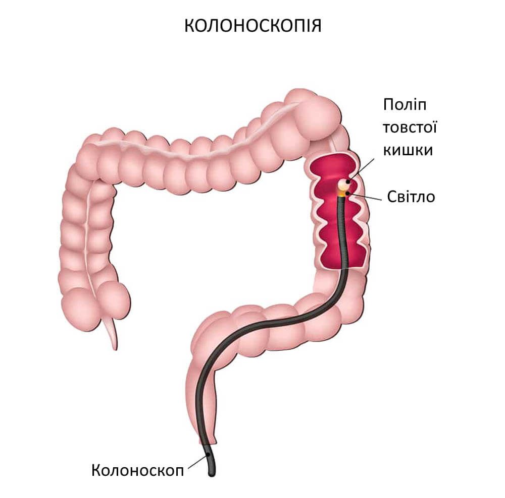 Колоноскопія кишківника в обласній клінічній лікарні Запоріжжя