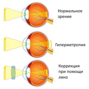 Лечение дальнозоркости в Запорожье