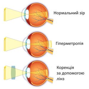 Лікування далекозорості у Запоріжжі