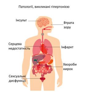 Лікування гіпертонічної хвороби у Запоріжжі