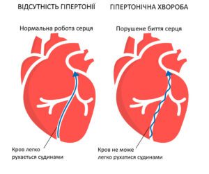 Лікування гіпертонічної хвороби у Запоріжжі
