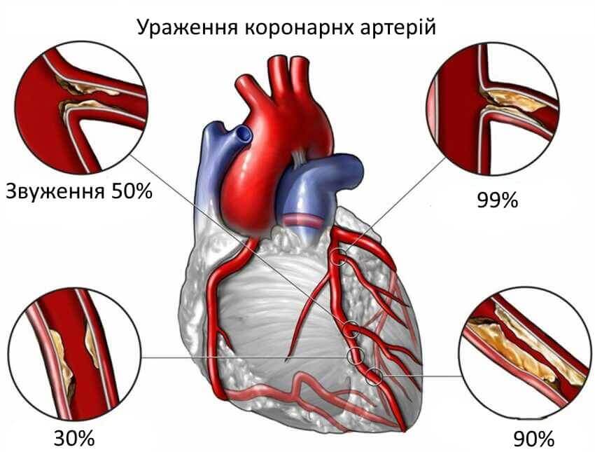 Лікування ішемічної хвороби серця у Запоріжжі