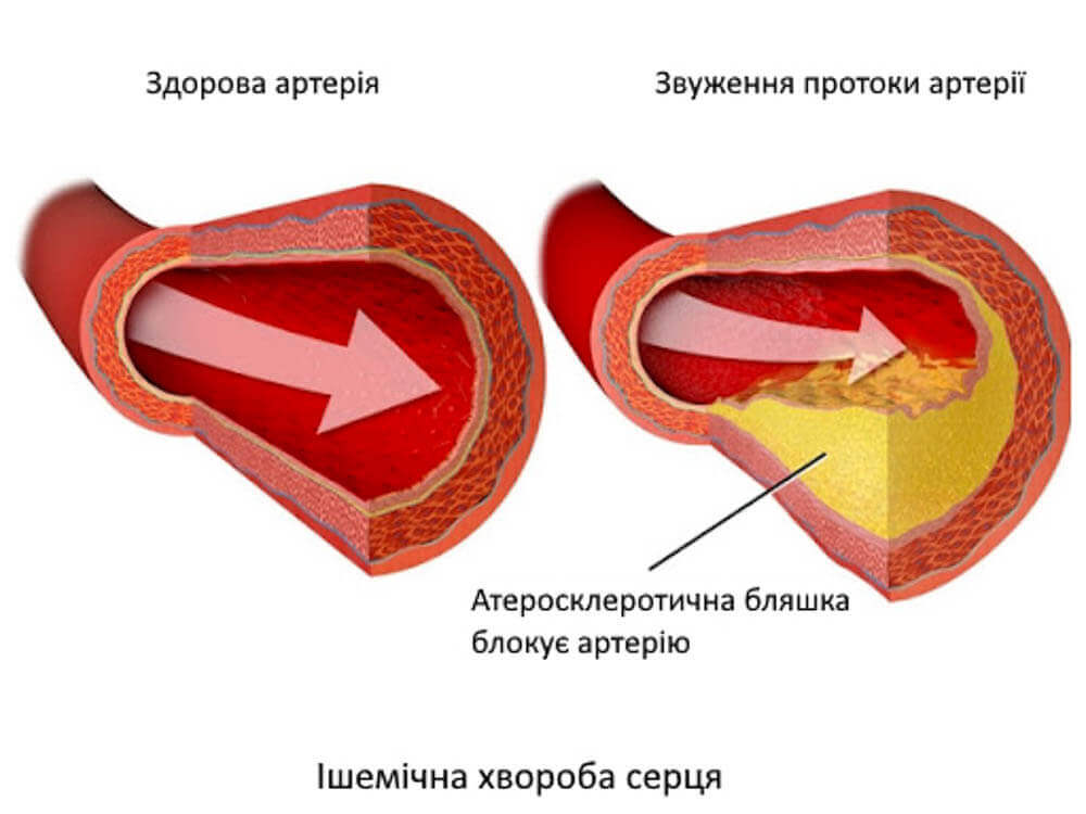 Лікування ішемічної хвороби серця у Запоріжжі