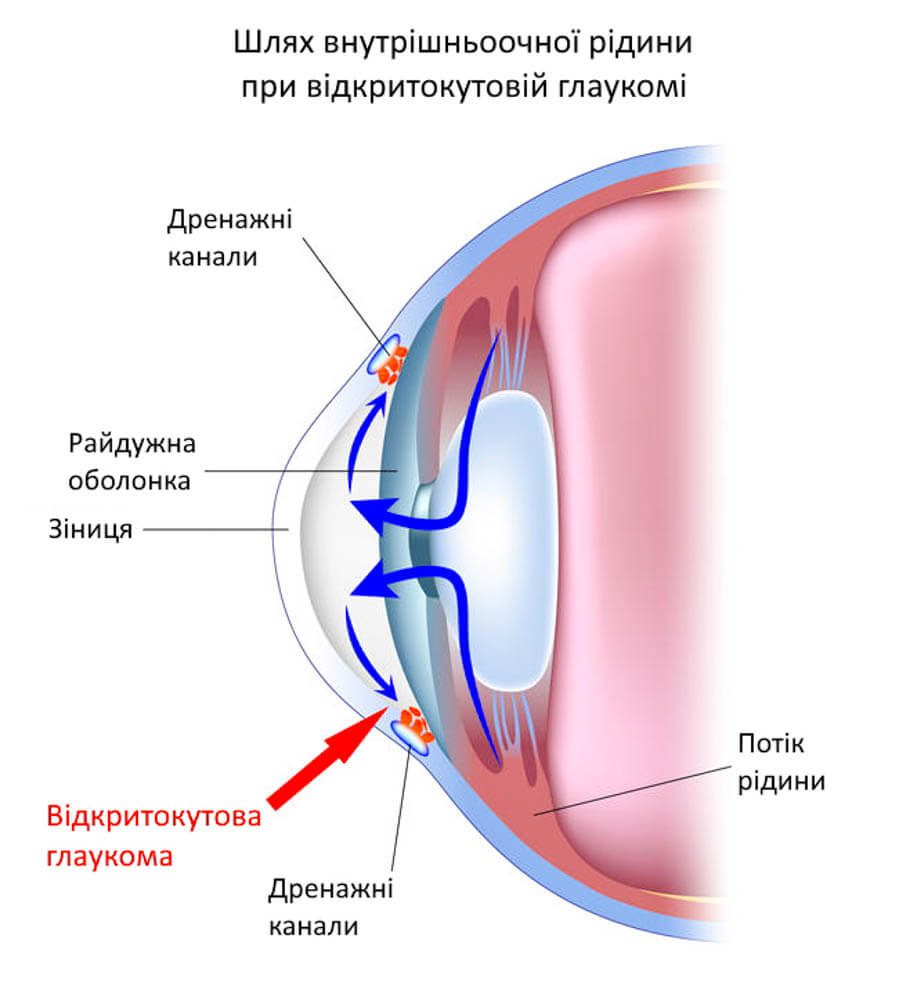 Лікування відкритокутової глаукоми у Запоріжжі
