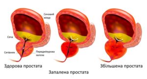 Лікування простатиту у Запоріжжі