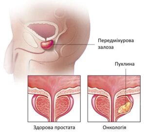 Лікування раку простати у Запоріжжі