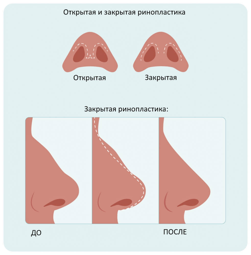 Ринопластика в Запорожье Ринопластика в Запорожье