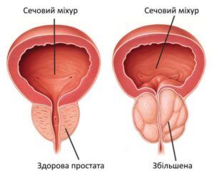 Видалення аденоми простати у Запоріжжі