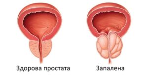 Видалення простати у Запоріжжі