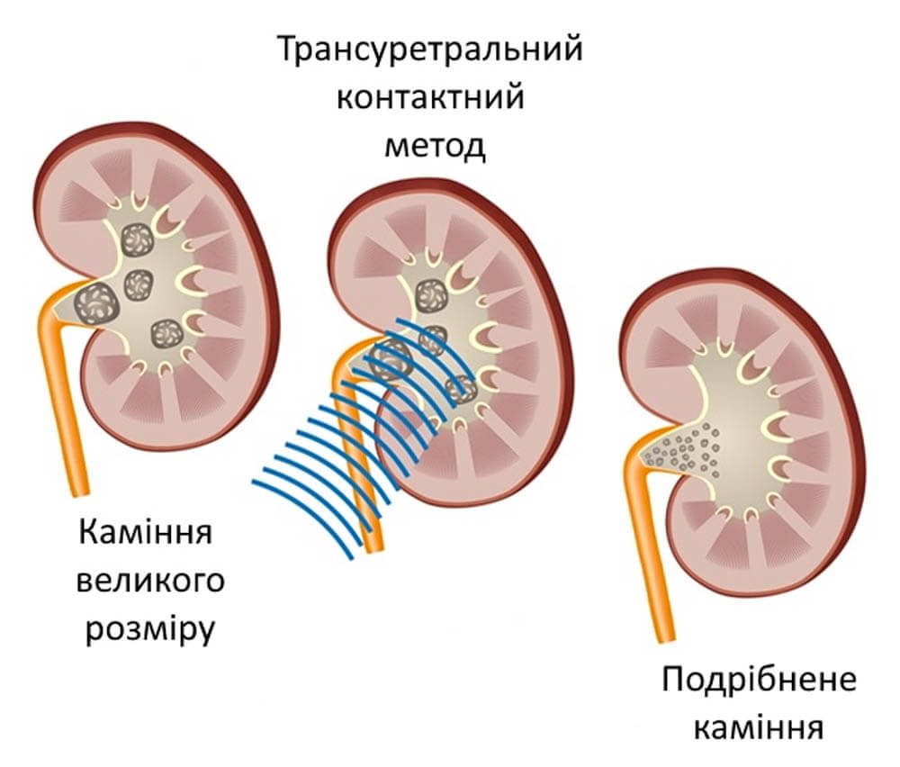 Контактне дроблення каміння у Запоріжжі