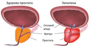 Лікування хронічного простатиту у Запоріжжі