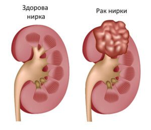 Лікування нирки у Запоріжжі