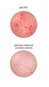 Лікування циститу у Запоріжжі