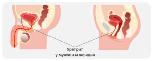 Лечение уретрита в Запорожье
