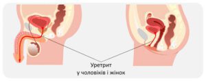 Лікування уретриту у Запоріжжі Лікування уретриту у Запоріжжі