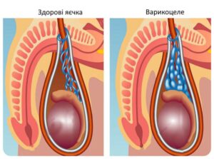 Лікування варикоцеле у Запоріжжі