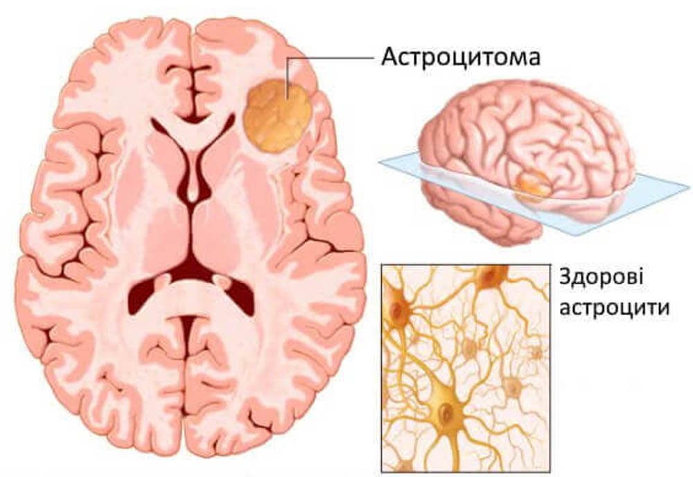 Лікування астроцитоми головного мозку у Запоріжжі Лікування астроцитоми головного мозку у Запоріжжі
