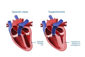 Лікування кардіоміопатії у Запоріжжі