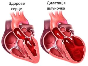 Лечение приобретённых пороков сердца в областной больнице Запорожья