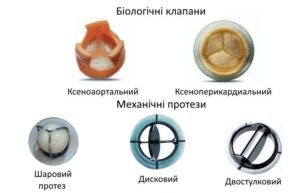 Лечение приобретённых пороков сердца в областной больнице Запорожья